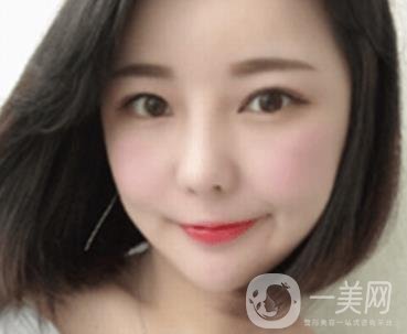 廣州博仕整形醫(yī)院做鼻子多少錢?價格表和整形恢復日記一覽