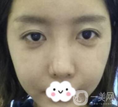 泉州二院整形外科可以打玻尿酸嗎？附價格表及玻尿酸隆鼻案例