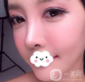 泉州二院整形外科可以打玻尿酸嗎？附價格表及玻尿酸隆鼻案例