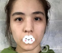 上海伯思立整形怎么樣？附沈國(guó)雄隆鼻案例及整形價(jià)格表