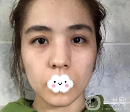 上海伯思立整形怎么樣？附沈國雄隆鼻案例及整形價格表