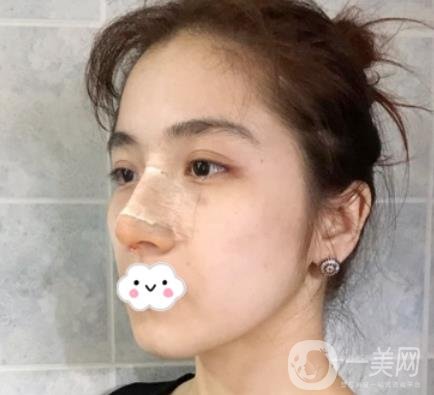 上海伯思立整形怎么樣？附沈國雄隆鼻案例及整形價格表