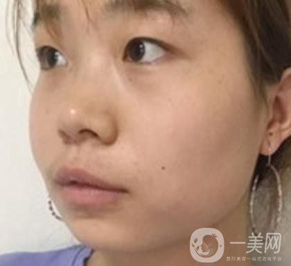 上海華美李志海磨骨多少錢？案例有嗎？整形價(jià)格表一覽