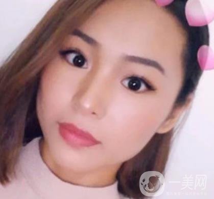 上海九院切下頜角手術(shù)經(jīng)歷分享，附2020整形價(jià)格一覽表