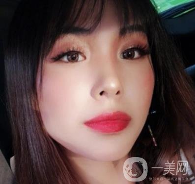 上海九院切下頜角手術(shù)經(jīng)歷分享，附2020整形價(jià)格一覽表