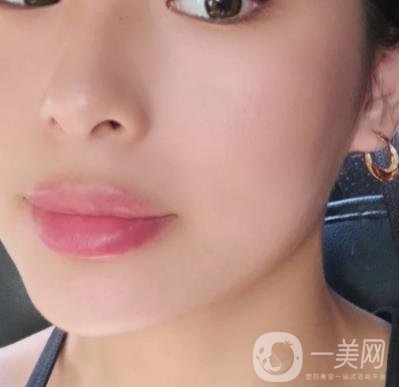上海九院切下頜角手術(shù)經(jīng)歷分享，附2020整形價(jià)格一覽表