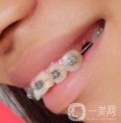 長征醫(yī)院整牙價格表，牙齒整形恢復(fù)果展示