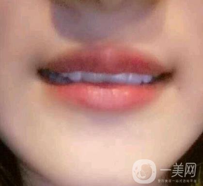 北京市海淀醫(yī)院整牙多少錢？看價(jià)格表及案例*果