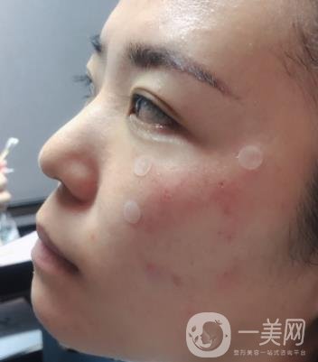 吉大一院整形美容科價(jià)格表費(fèi)用明細(xì)，附祛斑案例