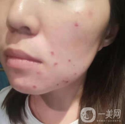 吉大一院整形美容科價(jià)格表費(fèi)用明細(xì)，附祛斑案例