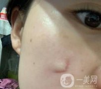 河北省中醫(yī)院整形美容科去疤果如何？?jī)r(jià)格表及案例實(shí)拍圖公布