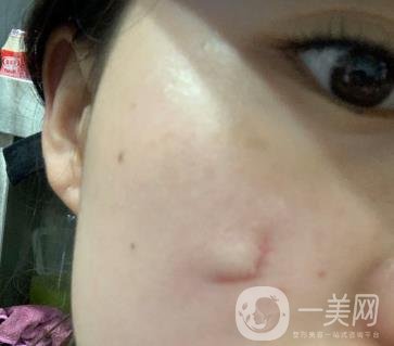河北省中醫(yī)院整形美容科去疤*果如何？價格表及案例實拍圖公布