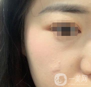 河北省中醫(yī)院整形美容科去疤*果如何？價格表及案例實拍圖公布