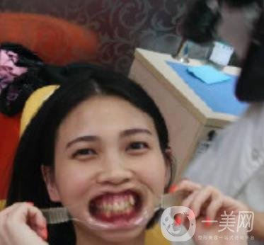 南昌大學第二附屬醫(yī)院整牙60天案例，還有價格表哦