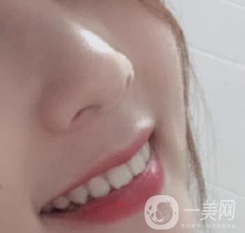 南昌大學第二附屬醫(yī)院整牙60天案例，還有價格表哦