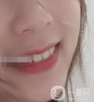 南昌大學第二附屬醫(yī)院整牙60天案例，還有價格表哦