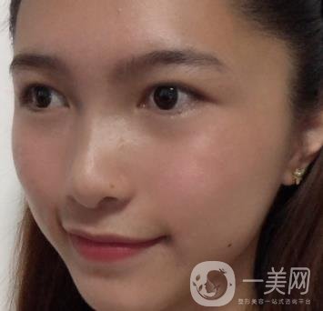 沈陽軍區(qū)總醫(yī)院整形外科價格表2020，附雙眼皮案例