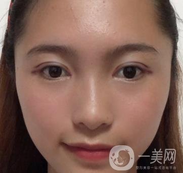 沈陽軍區(qū)總醫(yī)院整形外科價格表2020，附雙眼皮案例