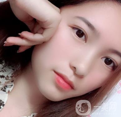 沈陽軍區(qū)總醫(yī)院整形外科價格表2020，附雙眼皮案例