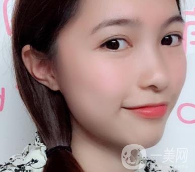沈陽軍區(qū)總醫(yī)院整形外科價格表2020，附雙眼皮案例