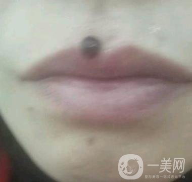 鹽城東方女子整形醫(yī)院價格表_點(diǎn)痣*果一覽
