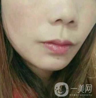 鹽城東方女子整形醫(yī)院價格表_點(diǎn)痣*果一覽