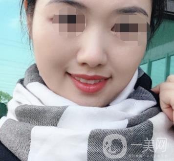鹽城東方女子整形醫(yī)院價格表_點(diǎn)痣*果一覽