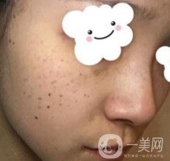 浙二醫(yī)院整形美容科價格表*新版，附激光祛斑*終*果圖