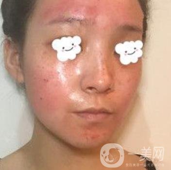 浙二醫(yī)院整形美容科價格表*新版，附激光祛斑*終*果圖