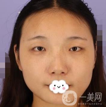 北京安貞醫(yī)院整容怎么樣？李斌斌修復(fù)雙眼皮怎么樣？?jī)?nèi)含案例及價(jià)格表
