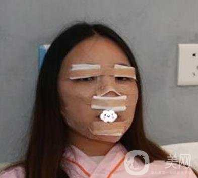 北京安貞醫(yī)院整容怎么樣？李斌斌修復(fù)雙眼皮怎么樣？?jī)?nèi)含案例及價(jià)格表