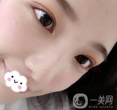 北京安貞醫(yī)院整容怎么樣？李斌斌修復(fù)雙眼皮怎么樣？?jī)?nèi)含案例及價(jià)格表