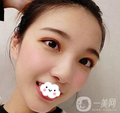 北京安貞醫(yī)院整容怎么樣？李斌斌修復(fù)雙眼皮怎么樣？?jī)?nèi)含案例及價(jià)格表