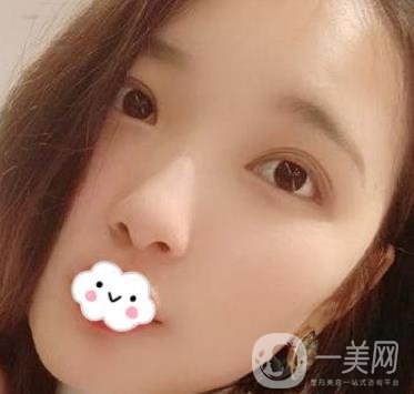 北京安貞醫(yī)院整容怎么樣？李斌斌修復(fù)雙眼皮怎么樣？?jī)?nèi)含案例及價(jià)格表