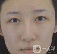 北京克萊美舍張冰潔雙眼皮評(píng)價(jià)怎么樣？案例及價(jià)格表一覽