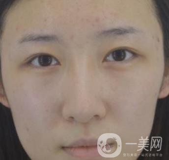 北京克萊美舍張冰潔雙眼皮評價怎么樣？案例及價格表一覽