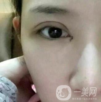 北京克萊美舍張冰潔雙眼皮評價怎么樣？案例及價格表一覽