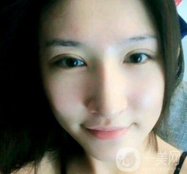 北京克萊美舍張冰潔雙眼皮評價怎么樣？案例及價格表一覽
