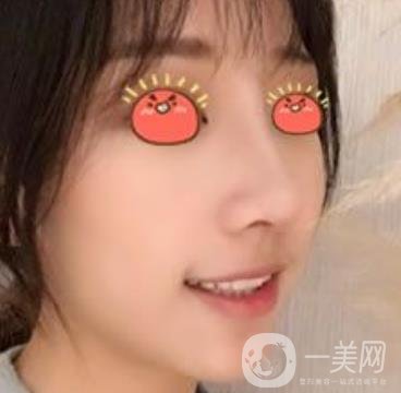 廣東省人民醫(yī)院隆鼻案例及整形價(jià)格表分享