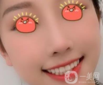 廣東省人民醫(yī)院隆鼻案例及整形價(jià)格表分享