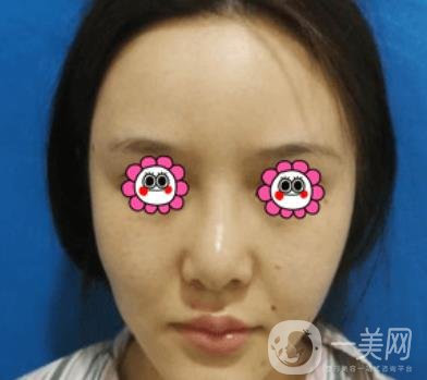 長(zhǎng)沙中南大學(xué)*三醫(yī)院整形美容外科隆鼻多少錢？?jī)r(jià)格表及案例詳情
