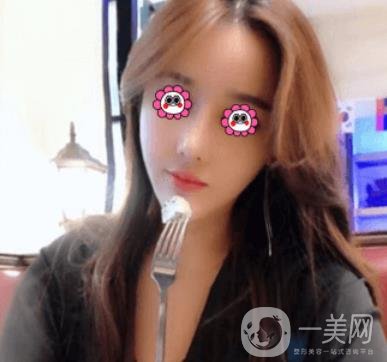 長(zhǎng)沙中南大學(xué)*三醫(yī)院整形美容外科隆鼻多少錢？?jī)r(jià)格表及案例詳情