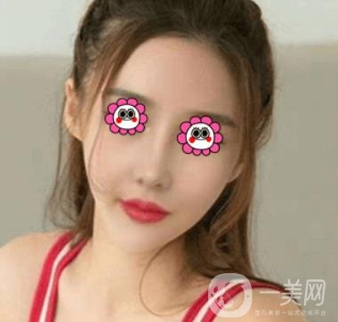 長(zhǎng)沙中南大學(xué)*三醫(yī)院整形美容外科隆鼻多少錢？?jī)r(jià)格表及案例詳情