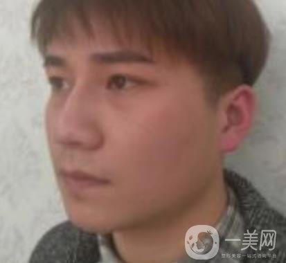 棗莊市立醫(yī)院燒傷整形美容科做光子嫩膚好嗎？?jī)r(jià)格表及術(shù)后*果分享