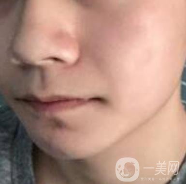 棗莊市立醫(yī)院燒傷整形美容科做光子嫩膚好嗎？?jī)r(jià)格表及術(shù)后*果分享