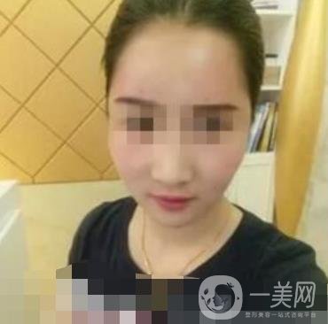 邢臺(tái)市人民醫(yī)院美容科陳譽(yù)華*案例_價(jià)格表明細(xì)