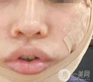四川省人民醫(yī)院整形外科游曉波磨骨怎么樣?價(jià)格收費(fèi)明細(xì)表一覽