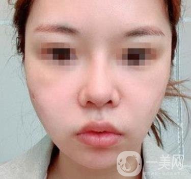 四川省人民醫(yī)院整形外科游曉波磨骨怎么樣?價(jià)格收費(fèi)明細(xì)表一覽