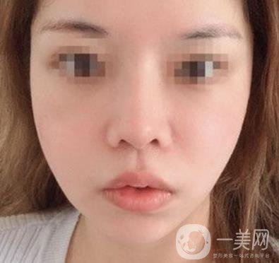 四川省人民醫(yī)院整形外科游曉波磨骨怎么樣?價(jià)格收費(fèi)明細(xì)表一覽