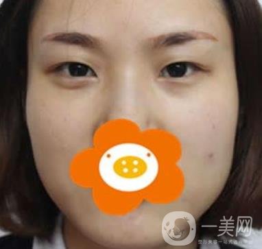 成都*做雙眼皮前后*果圖，附整形美容科價(jià)格收費(fèi)表一覽